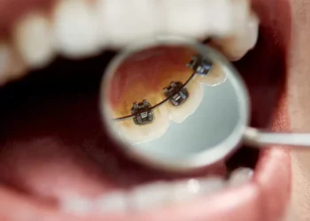 ¿Buscas un tratamiento dental para tus hijos? Conoce todo lo que debes asimilar sobre la ortodoncia lingual para niños y adolescentes 