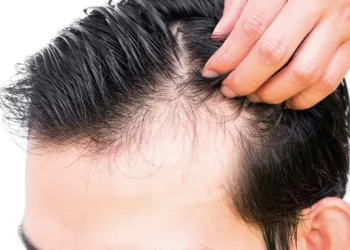 Fin al trauma de la alopecia en hombres: 81% de los chilenos reconoce haber experimentado pérdida de melena